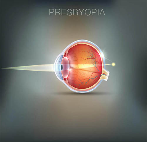 Chart Illustrating How Presbyopia Affects an Eye