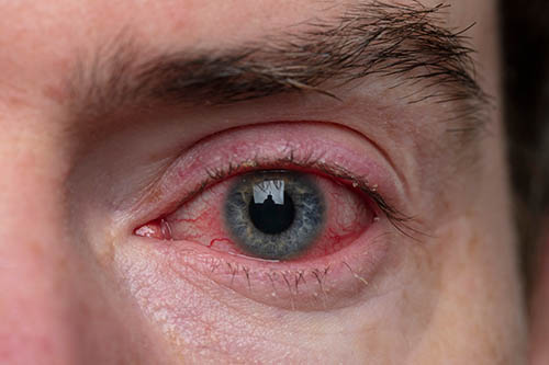 Red Eyes San Luis Obispo | Dry Eye Paso Robles | Pacific Eye Surgeons