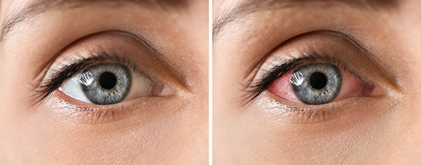 Healthy Eye Compared to One With Uveitis